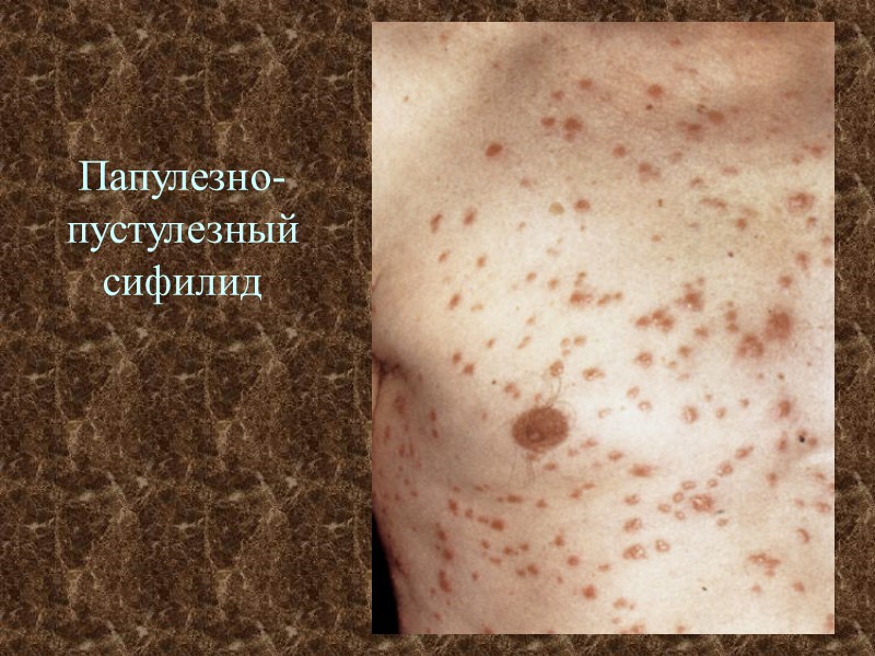 Папулезно-пустулезный сифилид